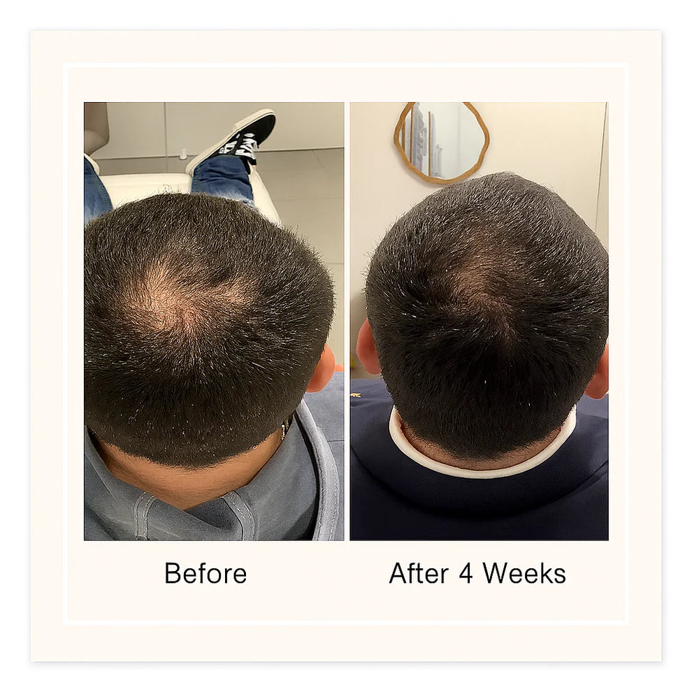 Vitala Advanced Hair Growth Roll-On Serum 2