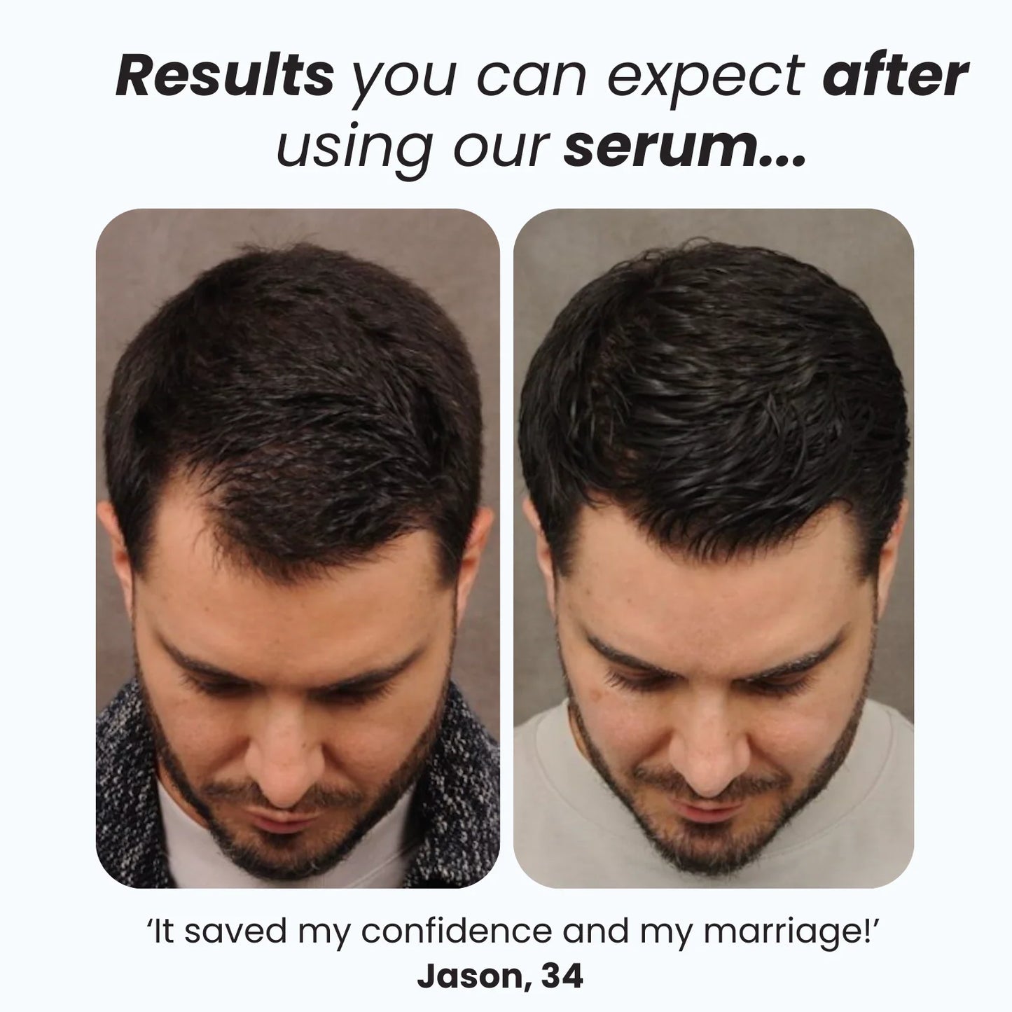 Vitala Advanced Hair Growth Roll-On Serum 2